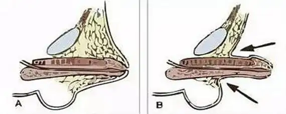 缩阳入腹是啥意思
