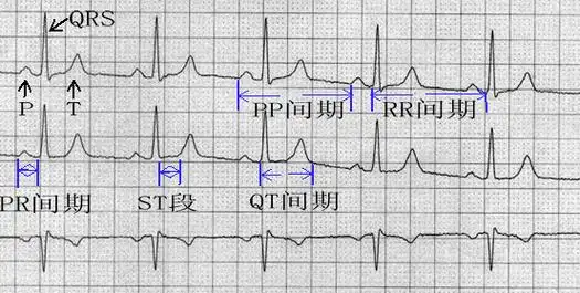 心电图系列科普知识——基本波形之一(六) - 好大夫在线