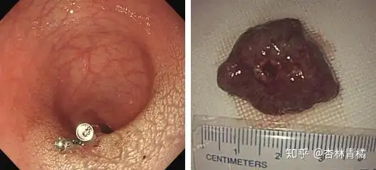 图1 患儿直肠巨大幼年性息肉内镜下电切术图2 患儿术后麻醉复苏中.