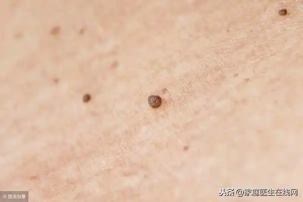长了扁平疣怎么办?试试3个方法,"消灭"这些小疙瘩