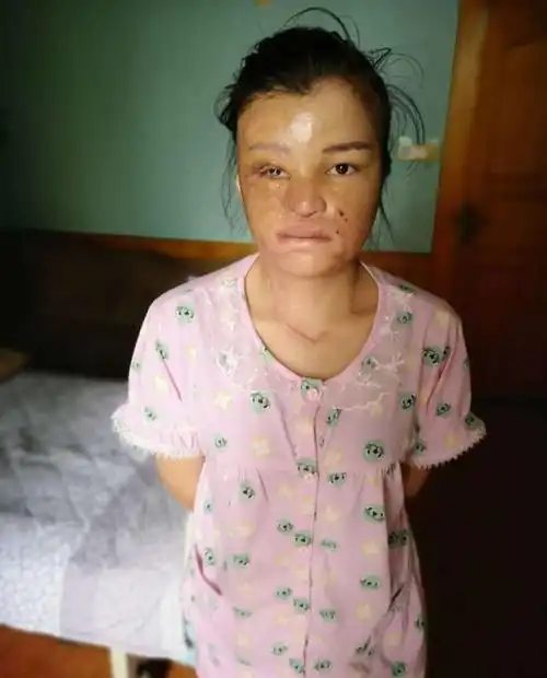 仁爱救助为烧伤毁容疤痕女点燃生活希望