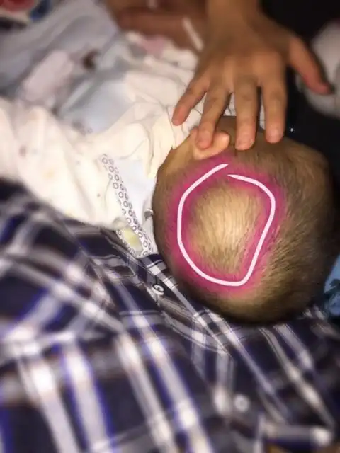 推荐回答 您好:上述的情况一般多见于皮脂腺瘤或者是脂肪瘤等因素所