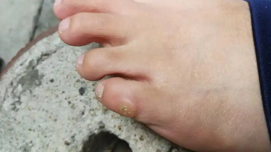 脚趾外侧长了一个类似水泡硬硬的,不疼.不知道是什么东西