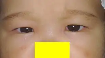 婴儿性(先天性)内斜视_小儿斜视_小儿斜视疾病介绍 - 好大夫在线