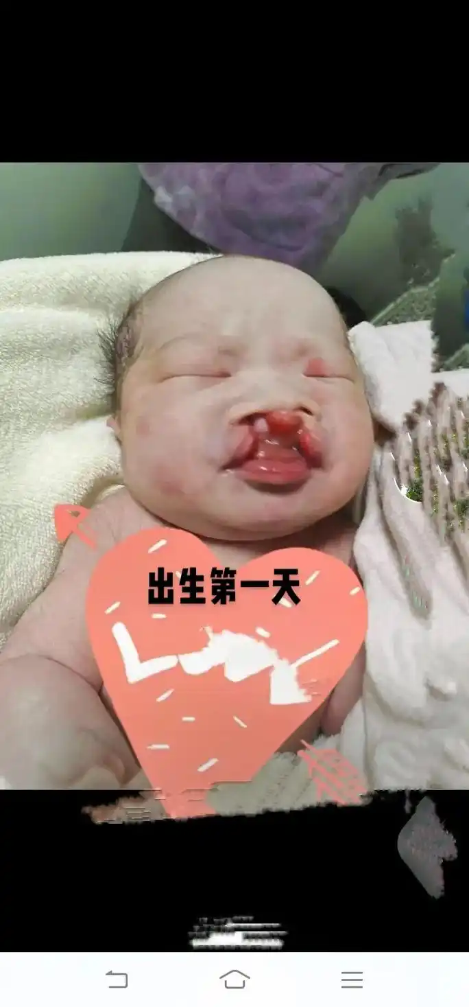 唇腭裂正能量分享 这一路走来宝宝不知道哭了多少次,特别是增 - 抖音