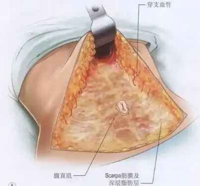 腹部拉皮术过程