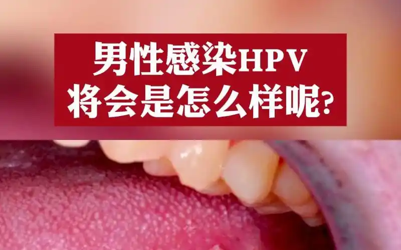 男性感染hpv,会出现这3种情况