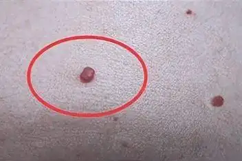 不痛不痒的小红点_百度视频搜索