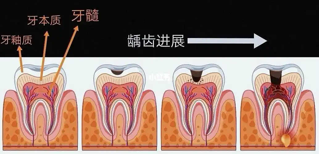 龋齿的进展