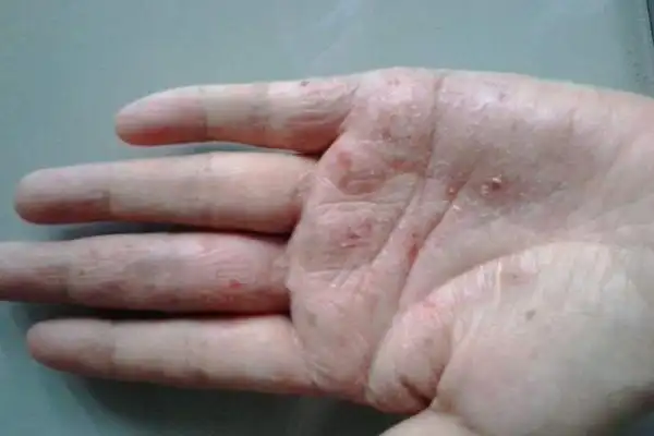手上起小水泡的原因 五种方法帮你缓解水泡