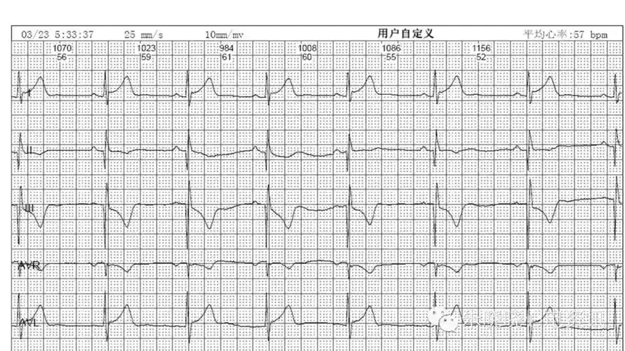 一个病人两份不同的心电图报告 - 好大夫在线
