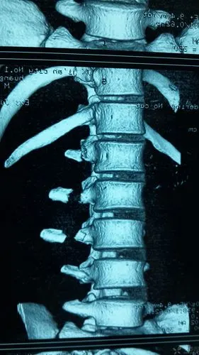 多发腰椎横突骨折一例,需要手术吗