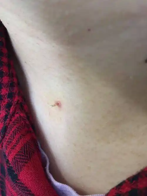 至于大家容易混淆的小"瘊子"也就是丝状疣,它只是病毒疣最常见