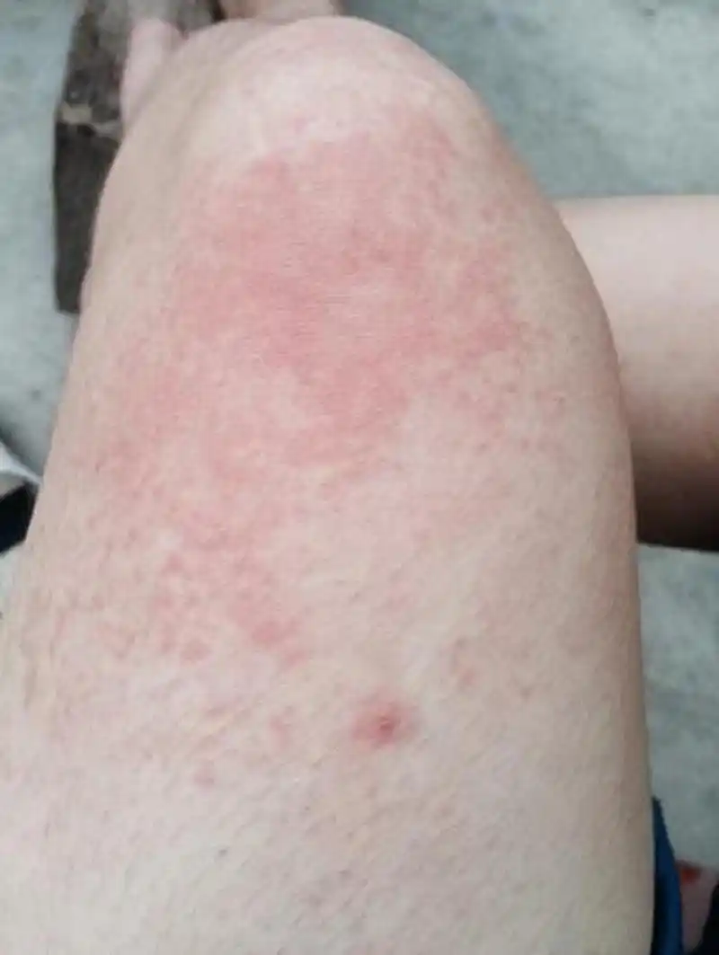 昨天接诊了一位小伙,乙肝多年未曾治疗,平时还经常的熬夜,喝酒,这次