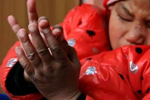 直击孤儿院的弃婴多数是残障儿童或身患罕见疾病