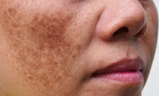 黄褐斑多见于中青年女性,影响面部美观性,可通过激光的方式治疗