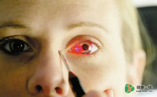 孔源性视网膜脱落诊断依据是?如何寻找视网膜裂孔?