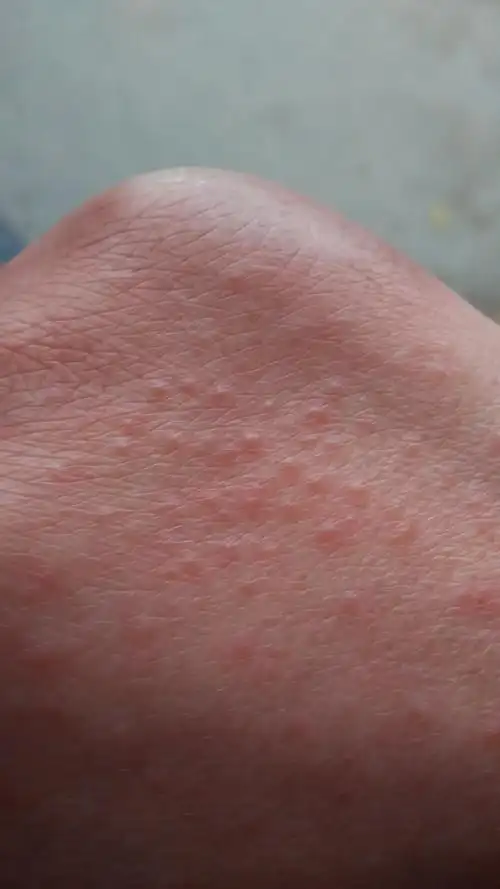 手面起了好多小疙瘩,密密麻麻的,是怎么回事?