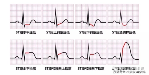 st段抬高不一定是心梗,这8张心电图必须鉴别!