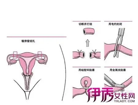 图上环的好处和坏处图片避孕上环坏处多