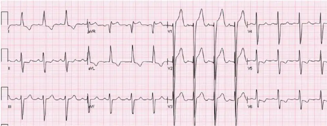 st段抬高不一定是心梗这8张心电图必须鉴别