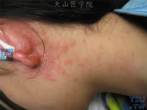 耳后细菌感染,局部化脓性分泌物外流刺激引起耳部下方及颈部皮肤红斑