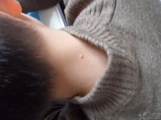 7月,伴瘙痒,尤其热时 体格检查:后颈部皮肤多个小包包,届清,无水泡,经