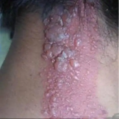 尖锐湿疣初期图片_男性湿锐疣初期症状图片