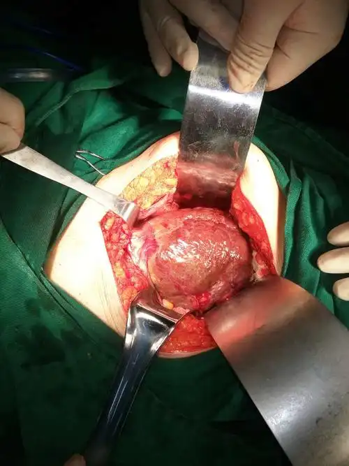 发生在肌层,通常患者的粘膜完整,藉此可以与腺癌,淋巴瘤等肿瘤相区别