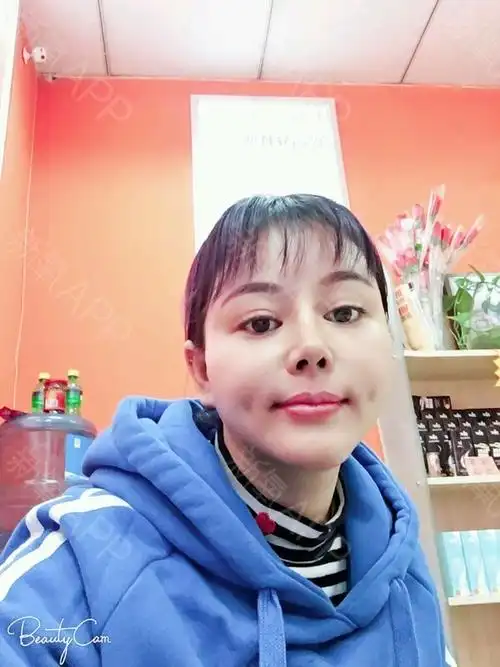 【整容案例】酒窝成形术(人造酒窝)|原来有了酒窝可以笑得这么没