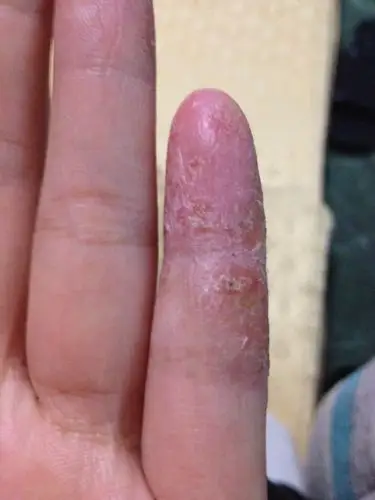 手癣可以吃什么药,擦什么要怎么治疗,我这个是手癣吗