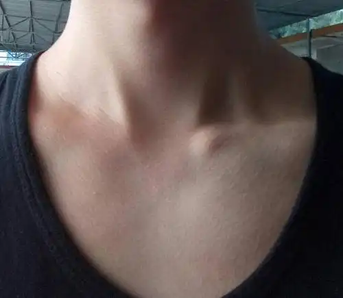 我的锁骨不对称,从小到大就这样,能不能纠正