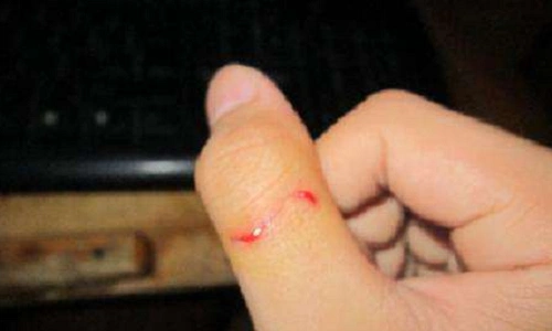 被老鼠咬伤应该怎么处理