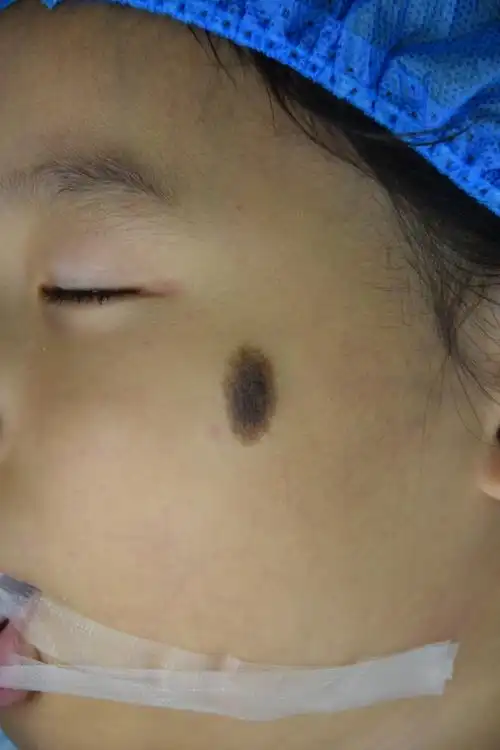 面部黑痣,今天术后4个月复查.开始点阵激光,进一步淡化瘢痕.