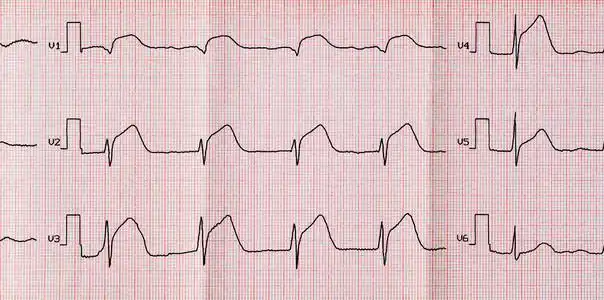 急性期 macrofocal 前壁心肌梗死心电图照片