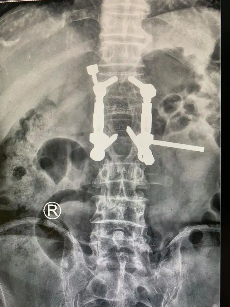 椎弓根螺钉.20多年前的椎弓根螺钉,看起来有点复杂,但设计十 - 抖音