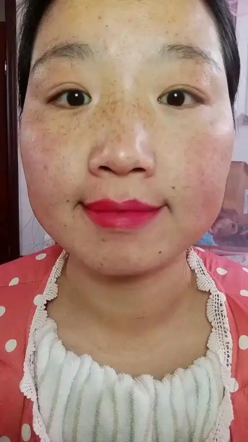 满脸麻子怎么办