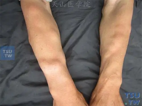 良性肿瘤:脂肪瘤(lipoma)症状表现