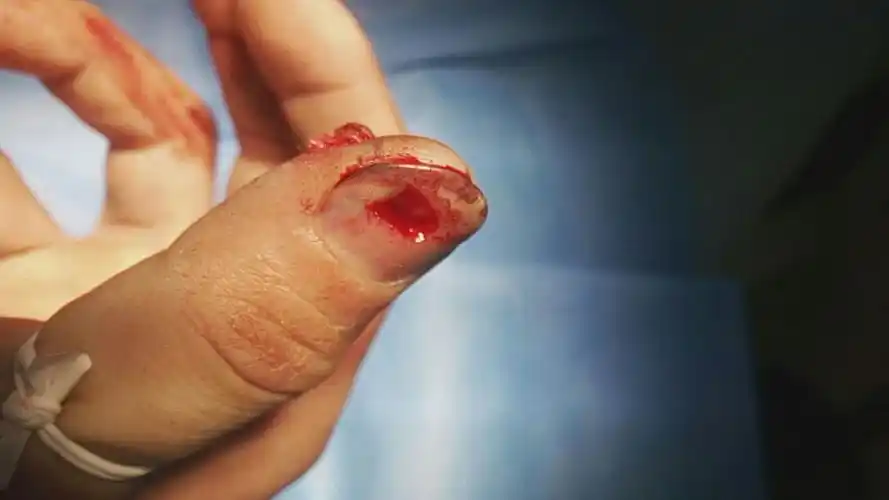 右手大拇指头穿透,粉碎性骨折,能评上伤残嘛?能评几级