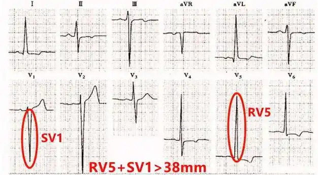 心电图发现左心室高电压是心脏病吗测个血压发现问题了