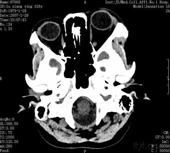 左侧上颌骨病变ct有病理20100618