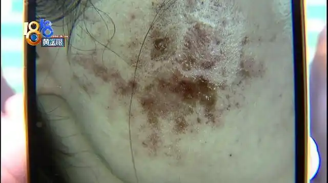 "光子嫩肤"脸上结痂,"聚美"认为情况正常