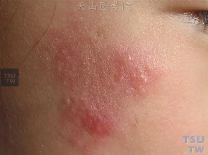 单纯疱疹(herpes simplex)症状表现