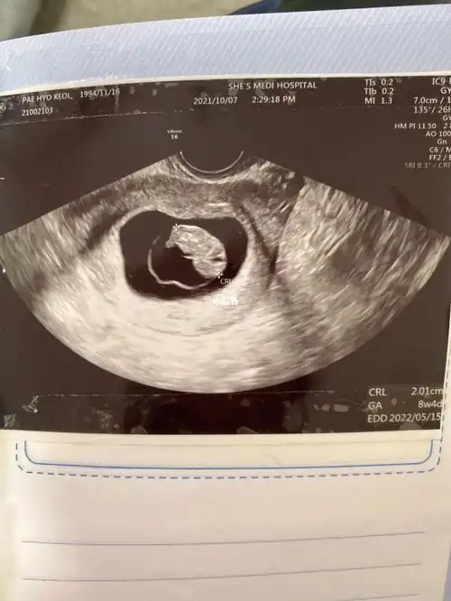 孕期检查(三),孕8周4天传你们胎心胎芽好孕