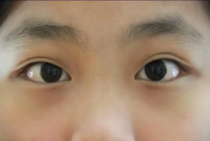 我这斗鸡眼能好吗,不动手术,我还近视400,怎么办?