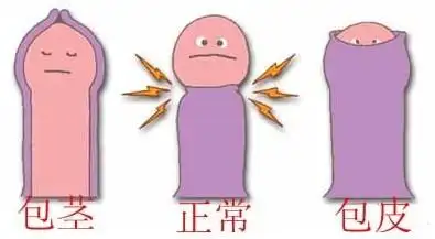 儿童包茎粘连怎么办