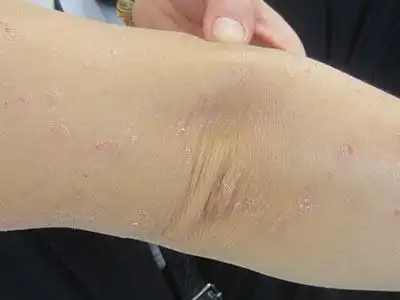 关注儿童银屑病患病刻不容缓