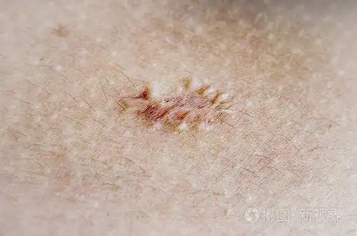 在皮肤上关闭瘢痕疙瘩疤痕