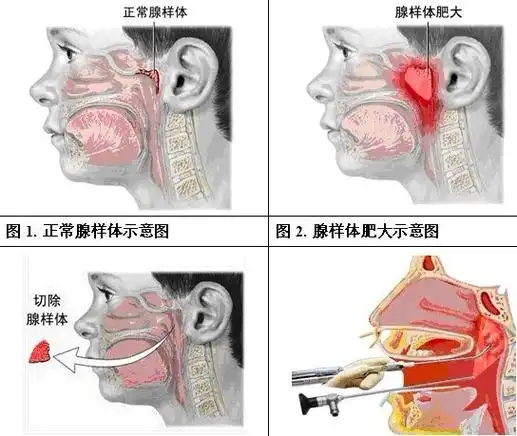 腺样体肥大?扁桃体肥大?