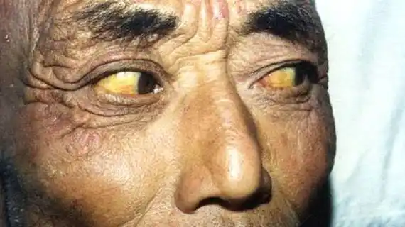 肝癌晚期面相 肝癌晚期面相特征图片_运势